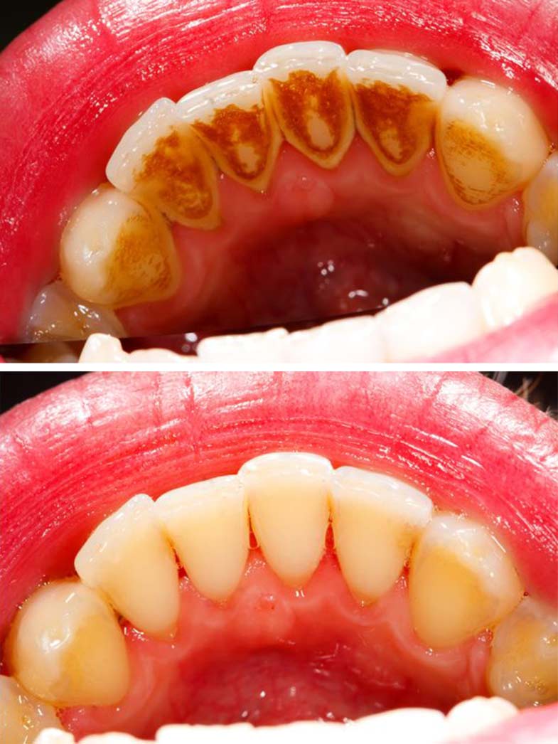 Scaling and Polishing